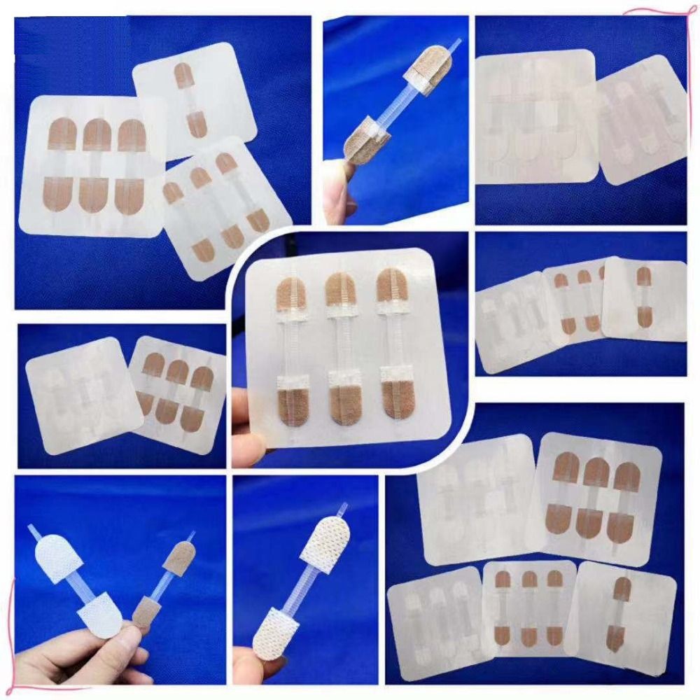 Zipper Tie Wound Closure Patch Hemostatic Patch Wound Fast Suture Zipper Band